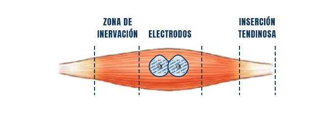 colocación de electrodos electromiografia dentro del vientre muscular