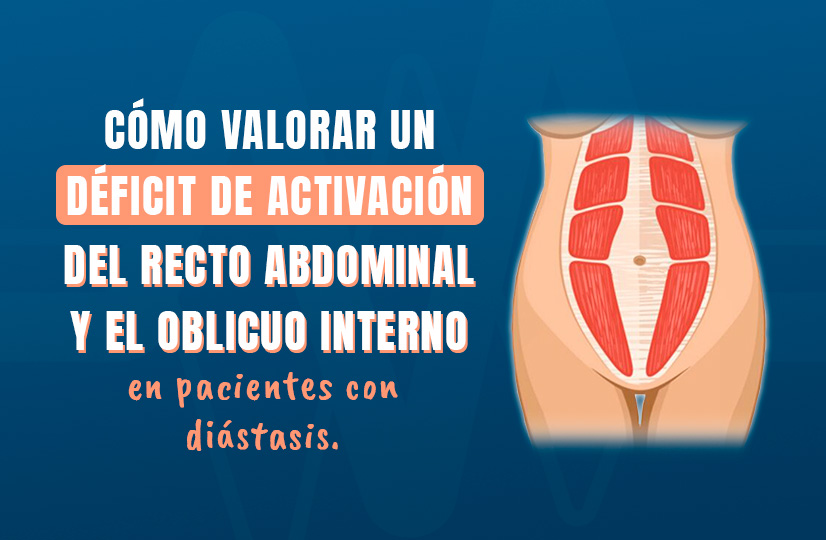 Cómo valorar un déficit de activación del recto abdominal y el oblicuo interno en pacientes con diástasis