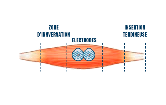 fiabilité de l'électromyographie