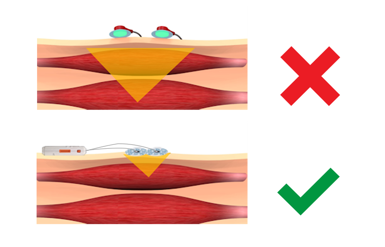 fiabilité de l'électromyographie